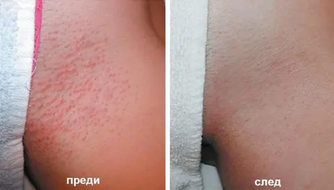 ЛАЗЕР ЦЕНТЪР Be Sexy — снимка 2 от сайта на фирмата