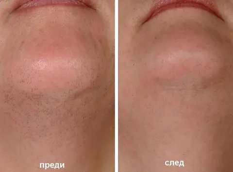 ЛАЗЕР ЦЕНТЪР Be Sexy — снимка 5 от сайта на фирмата